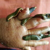Leech Therapy (Jaluka) in Ayurveda