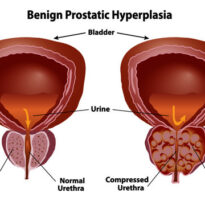 Ashtila (BPH – Benign Prostatic Hyperplasia):